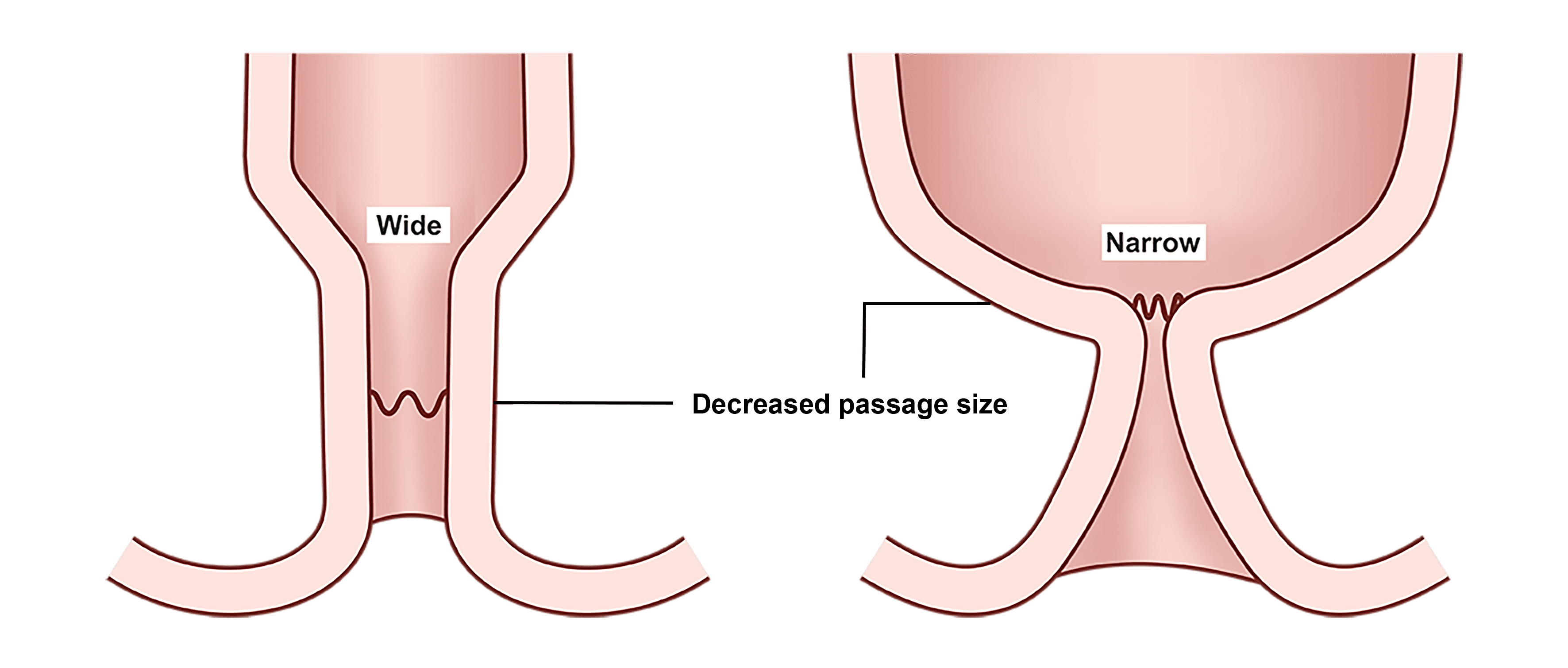 Anal Stenosis