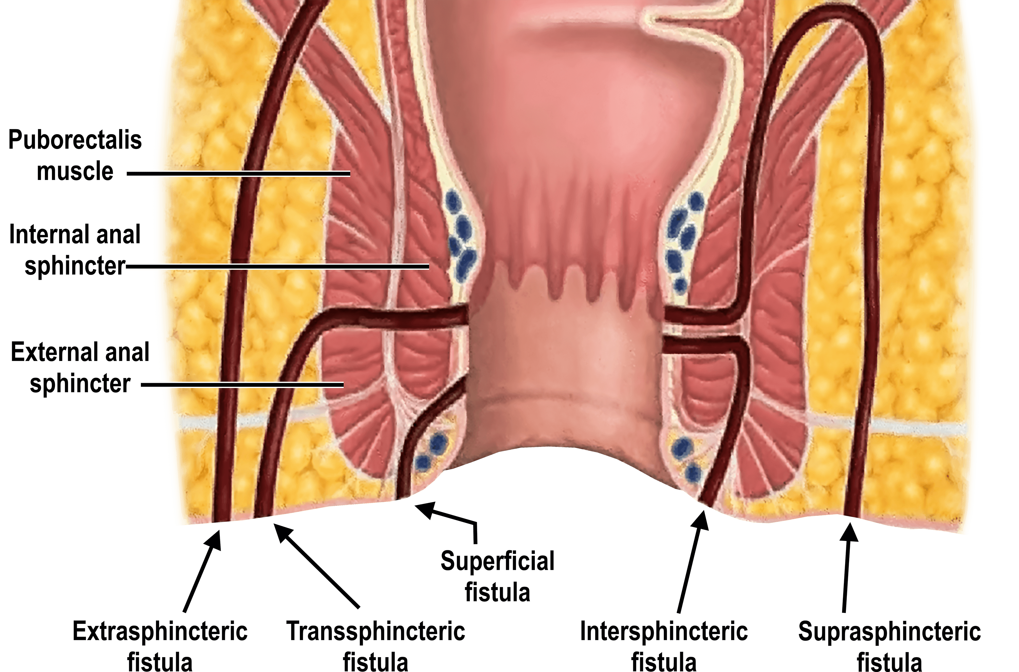 Fistula in Ano