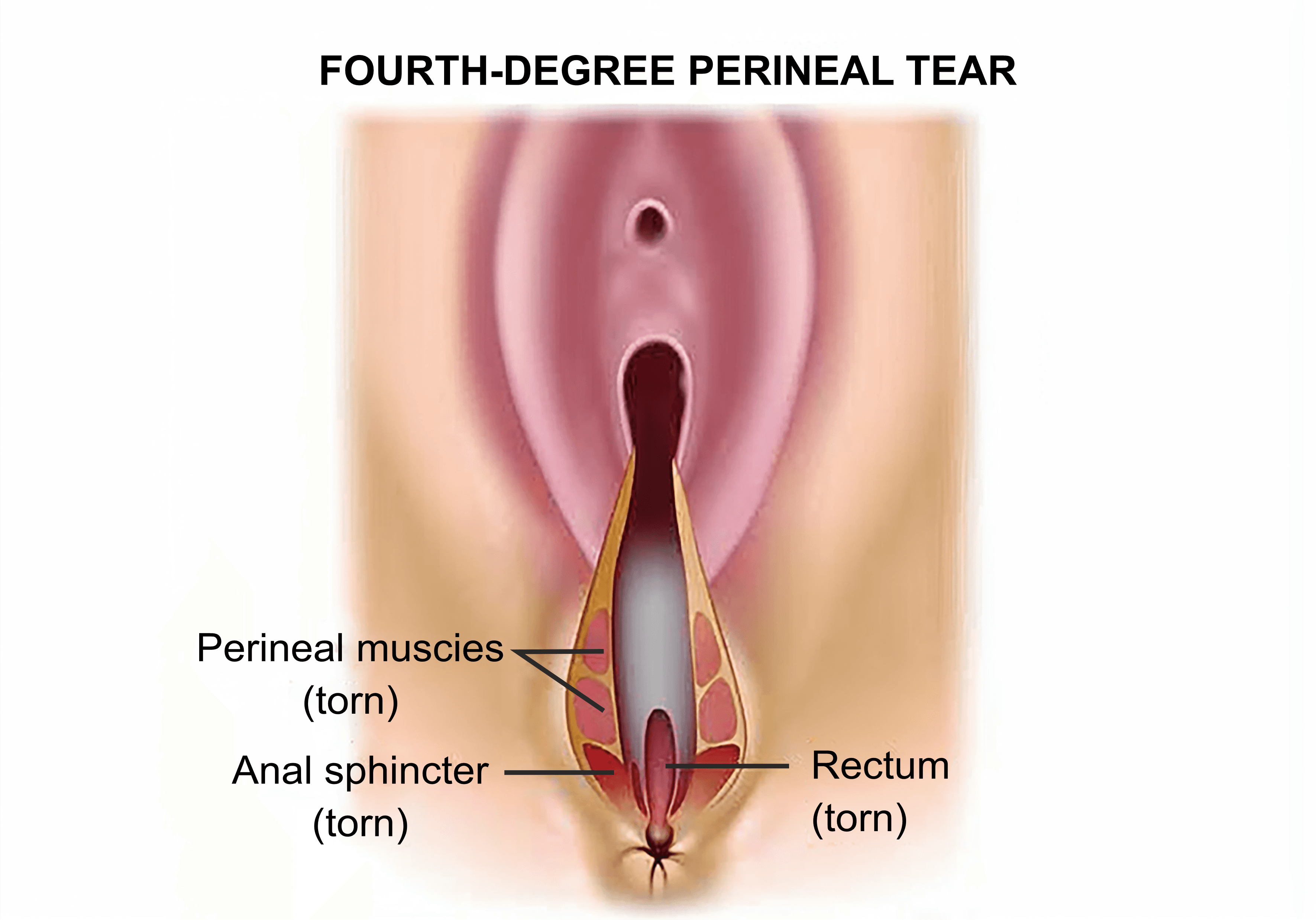 Perineal Tear