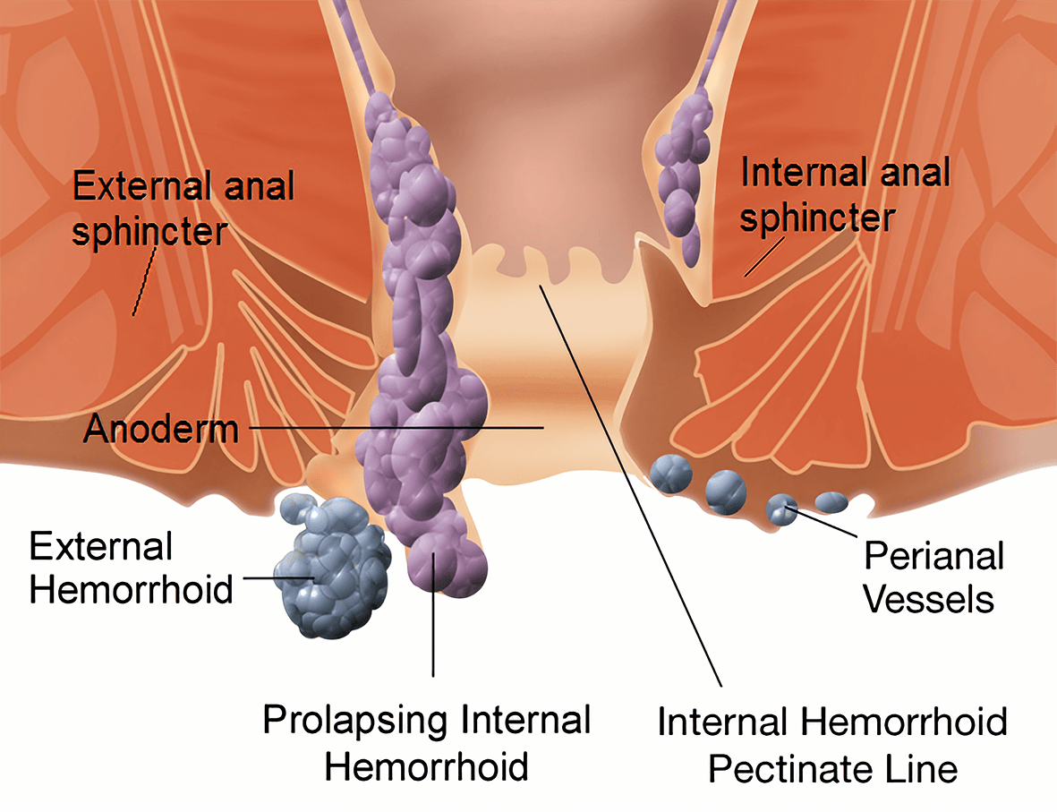 Piles (Haemorrhoids)