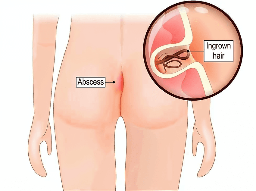 Pilonidal Sinus