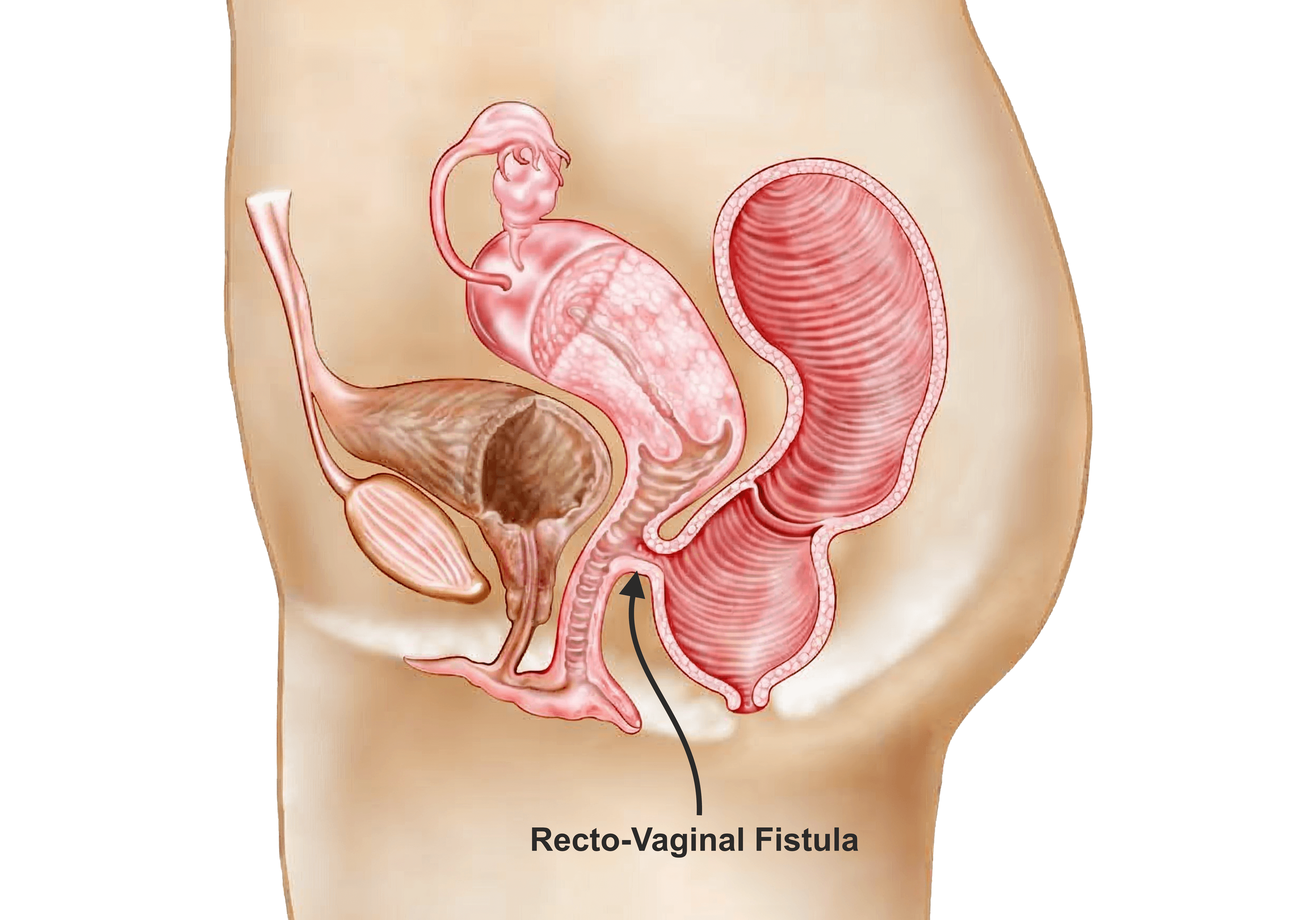 Recto-Vaginal Fistula